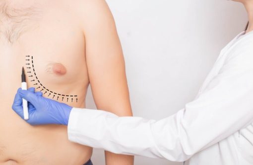 التثدي عند الرجال  GYNECOMASTIA   